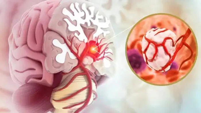 Beyin tümörlerinde baş ağrısı ve kusma kritik uyarı işareti olabilir