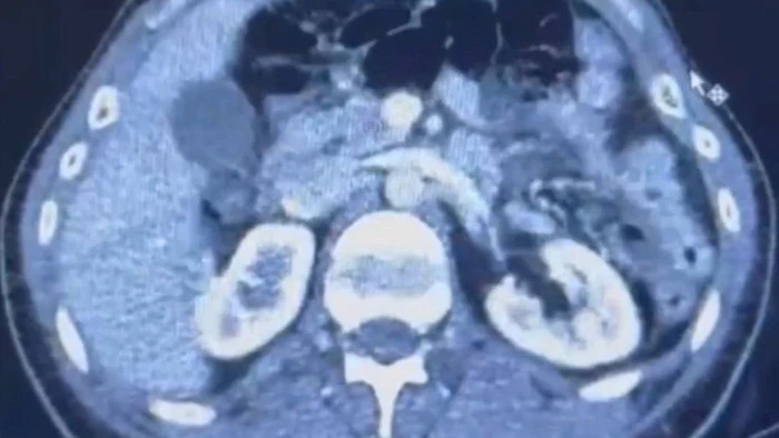 Kayseri'de midelerinde uyuşturucu bulunan 2 şüpheli gözaltına alındı